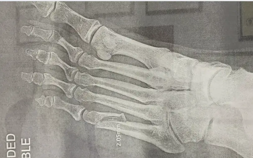 Axl Rose - Broken foot April 2016