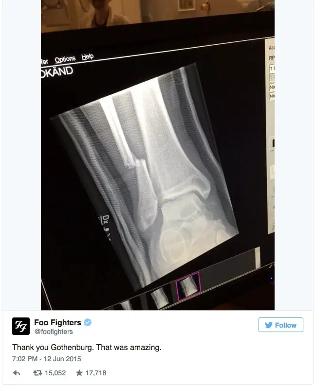 Dave Grohl's broken leg copy
